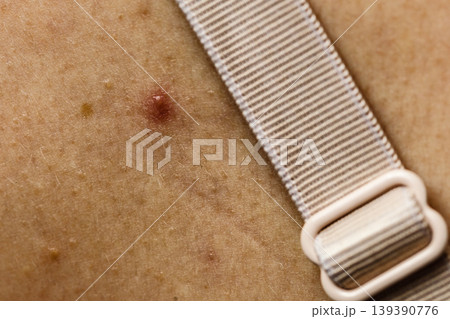 Closeup skin with acne moles and red spots. Closeup skin with acne moles and red spots. 139390776
