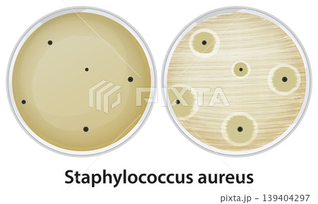 Staphylococcus Aureus Bacteria Growth and Inhibition in Petri Dishes Vector Illustration Staphylococcus Aureus Bacteria Growth and Inhibition in Petri Dishes Vector Illustration 139404297