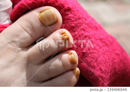 nail fungus 139406849