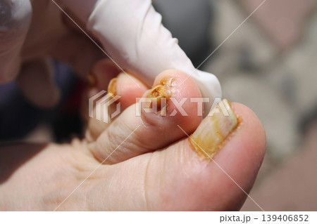 nail fungus nail fungus 139406852