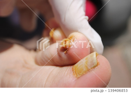 nail fungus nail fungus 139406853
