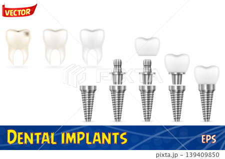 metal human tooth implant vector illustration 139409850