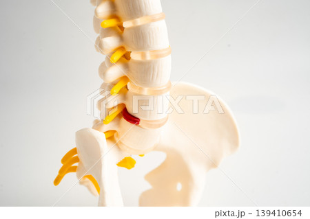 Spinal nerve and bone, Lumbar spine displaced herniated disc fragment, Model for treatment medical in the orthopedic department. 139410654