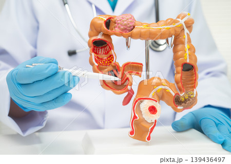 Colorectal cancer, doctor holding intestine colon human model. 139436497