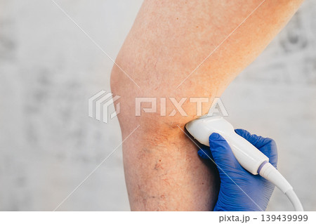 cropped ultrasound exam veins on the leg, vein thrombosis, varicose veins 139439999