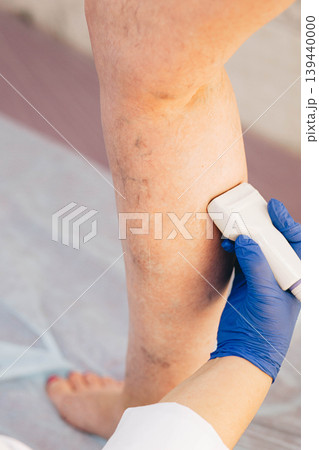 cropped ultrasound exam veins on the leg, vein thrombosis, varicose veins cropped ultrasound exam veins on the leg, vein thrombosis, varicose veins 139440000