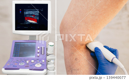 cropped ultrasound exam veins on the leg, vein thrombosis, varicose veins 139440077