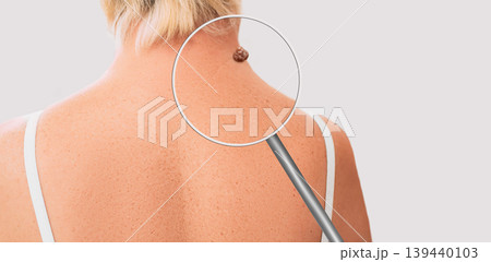 Magnifying glass showing mole on elderly woman skin. Preventive examination of a nevus on the human body Magnifying glass showing mole on elderly woman skin. Preventive examination of a nevus on the human body 139440103