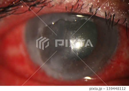 Close-up of a wide corneal epithelial defect observed during eye examination.  139448112