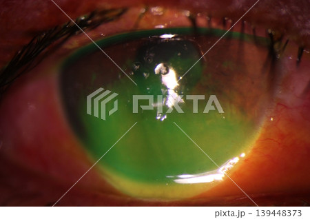 Anterior segment photography revealing corneal abrasion with positive fluorescein staining. Anterior segment photography revealing corneal abrasion with positive fluorescein staining. 139448373