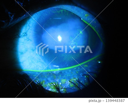 Close-up of punctate and round corneal abrasions during an eye examination. Close-up of punctate and round corneal abrasions during an eye examination. 139448387
