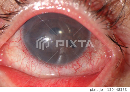 Anterior chamber intraocular lens with marked conjunctival hyperemia on eye examination. 139448388