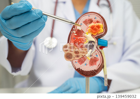 Chronic kidney disease, doctor with model for treatment urinary system, urology, Estimated glomerular filtration rate eGFR. Chronic kidney disease, doctor with model for treatment urinary system, urology, Estimated glomerular filtration rate eGFR. 139459032