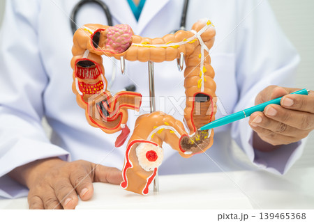 Colorectal cancer, doctor holding intestine colon human anatomy model. Colorectal cancer, doctor holding intestine colon human anatomy model. 139465368