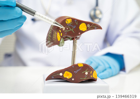 Cirrhosis, Liver cancer, fatty liver, Asian doctor with liver human anatomy model in World Hepatitis Day at hospital. Cirrhosis, Liver cancer, fatty liver, Asian doctor with liver human anatomy model in World Hepatitis Day at hospital. 139466319