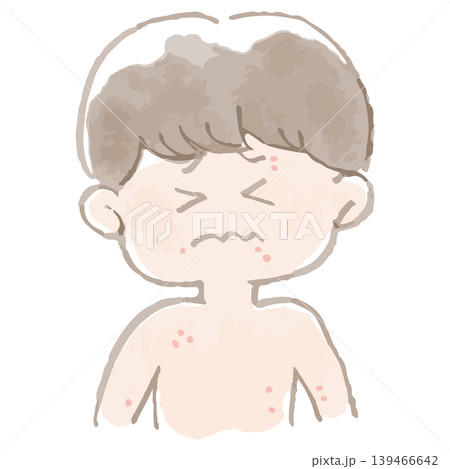 水彩風 とびひ・伝染性膿痂疹の症状イラスト 子供の皮膚の湿疹 優しいタッチ 皮膚科 小児科 139466642
