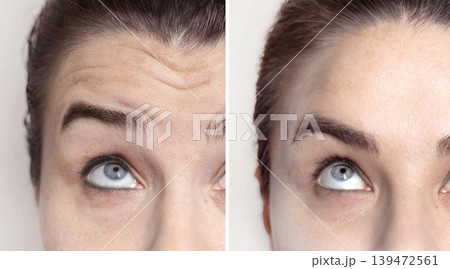 Caucasian woman before and after injections, visiting a beautician. woman with and without facial wrinkles. Collage photo Caucasian woman before and after injections, visiting a beautician. woman with and without facial wrinkles. Collage photo 139472561