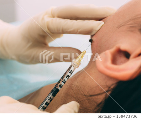 anesthesia injection into nevus on the female face, before radio wave electrocoagulation mole removing anesthesia injection into nevus on the female face, before radio wave electrocoagulation mole removing 139473736