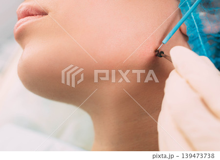 Patient getting mole removing with electrocautery and surgical tweezers on her face. Radio wave electrocoagulation remove method 139473738