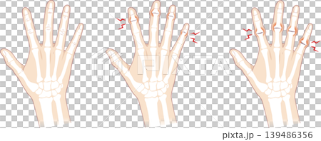 Normal fingers and bones of Heberden's nodes and Bouchard's nodes Normal fingers and bones of Heberden's nodes and Bouchard's nodes 139486356