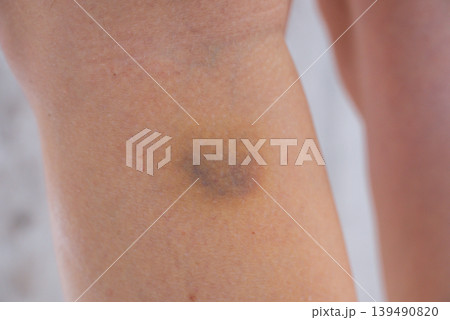 Unrecognizable woman with bruise on her leg. Close up of stain bruise wound on leg. Healing injury hematoma blood consequences of sport activity trauma. Extravasation 139490820