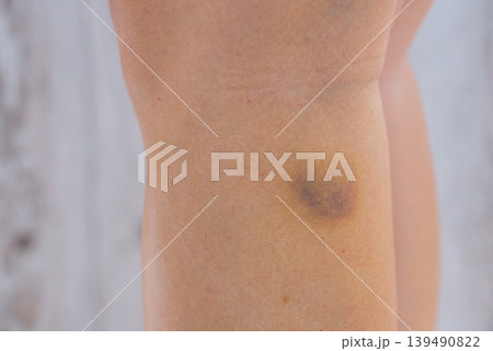 Unrecognized person with bruises on body at home scene. Close-up of woman with bruised leg. Bruising leg area, injury accident. Concept of home abuse. Consequences 139490822