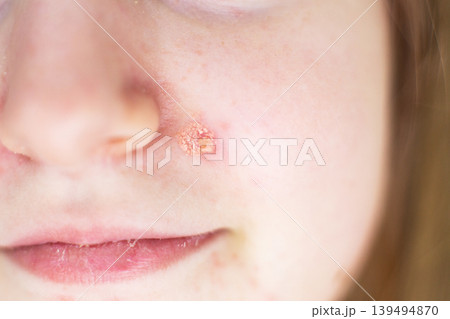 Child having impetigo skin infection chicken pox on face Child having impetigo skin infection chicken pox on face 139494870