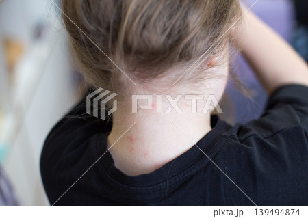 Child's neck with chickenpox showing skin rash and irritation 139494874