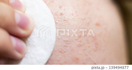 Forehead skin cleansing with cotton pad removing acne 139494877