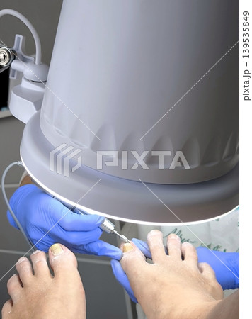 Medical Pedicure, Application of a Nail Correction System Medical Pedicure, Application of a Nail Correction System 139535849