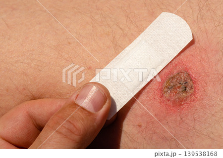 Applying adhesive bandage to skin wound Applying adhesive bandage to skin wound 139538168