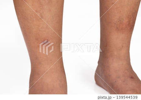 Senior man develop cellulitis in the lower leg. 139544539