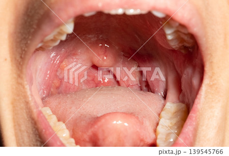 Open mouth showing sore throat with swollen uvula tonsils and posterior pharyngeal wall, influenza follicles in upper respiratory tract. Infection, diagnosis and clinical examination in healthcare. Open mouth showing sore throat with swollen uvula tonsils and posterior pharyngeal wall, influenza follicles in upper respiratory tract. Infection, diagnosis and clinical examination in healthcare. 139545766