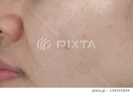 Asian woman with acne spot on facial skin before laser dermatology treatment. Pigmentation issue and skincare concern. Acne blemish and dark spot before laser skincare procedure in dermatology clinic. 139545844