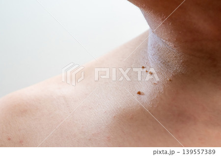 Close up detail of little skin tags or acrochordon at the neck of the man shot in a studio on white background. Close up detail of little skin tags or acrochordon at the neck of the man shot in a studio on white background. 139557389