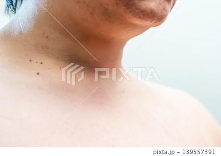 Close up detail of little skin tags or acrochordon at the neck of the man shot in a studio on white background. Close up detail of little skin tags or acrochordon at the neck of the man shot in a studio on white background. 139557391