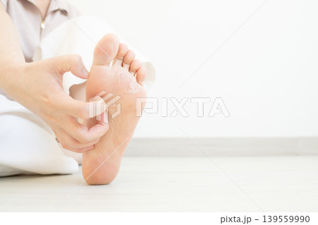 Woman scratching itchy feet that are peeling and cracked. Cause of itchy include athlete's foot (fungal infection), dermatitis (eczema), dry skin, dehydration or sweaty feet. Health care concept. 139559990