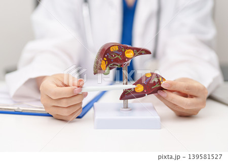 Doctor with human Liver anatomy model. Liver cancer and Tumor, Jaundice, Viral Hepatitis A, B, C, D, E, Cirrhosis, Failure, Enlarged, Hepatic Encephalopathy, Ascites Fluid in Belly and health concept Doctor with human Liver anatomy model. Liver cancer and Tumor, Jaundice, Viral Hepatitis A, B, C, D, E, Cirrhosis, Failure, Enlarged, Hepatic Encephalopathy, Ascites Fluid in Belly and health concept 139581527