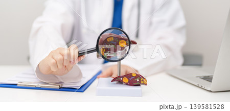 Doctor with human Liver anatomy model. Liver cancer and Tumor, Jaundice, Viral Hepatitis A, B, C, D, E, Cirrhosis, Failure, Enlarged, Hepatic Encephalopathy, Ascites Fluid in Belly and health concept Doctor with human Liver anatomy model. Liver cancer and Tumor, Jaundice, Viral Hepatitis A, B, C, D, E, Cirrhosis, Failure, Enlarged, Hepatic Encephalopathy, Ascites Fluid in Belly and health concept 139581528