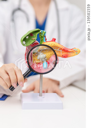 Doctor with human Pancreatitis anatomy model with Pancreas, Gallbladder, Bile Duct, Duodenum, Small intestine. Pancreatic cancer, Acute and Chronic pancreatitis, Digestive system and Health concept 139581559