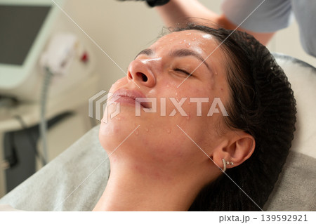 Facial Peeling Treatment Biorevitalization Concept Close Up 139592921