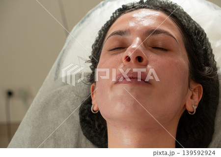 Young Woman After Facial Cosmetic Procedures Clean Skin Close Up 139592924
