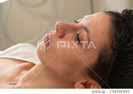 Facial Marking Before Cosmetic Injection Procedure Close Up Facial Marking Before Cosmetic Injection Procedure Close Up 139592945