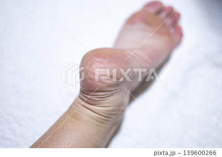 Dry skin on the feet, woman heel 139600266