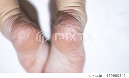 Dry skin on the feet, woman heel 139600342