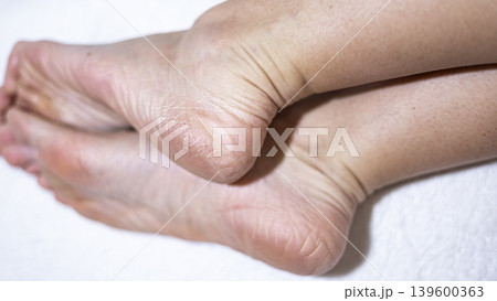 Dry skin on the feet, woman heel 139600363