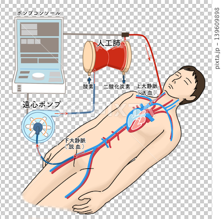 An illustration showing the structure of an ECMO (extracorporeal membrane oxygenation) device. 139609898
