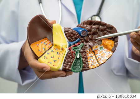 Cirrhosis, Liver cancer, fatty liver, Asian doctor with liver human model. 139610034