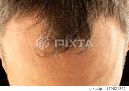 Man with short hair and distinct hairline stands against dark background Man with short hair and distinct hairline stands against dark background 139621262