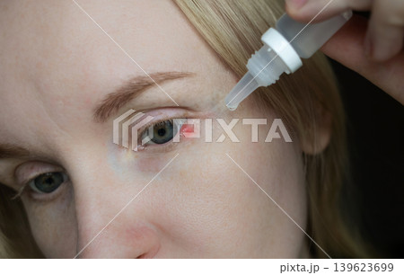 Close-up of a woman applying medical drops to treat a red eye stye or chalazion on the lower eyelid. Healthcare, ophthalmology and infection treatment concept. 139623699